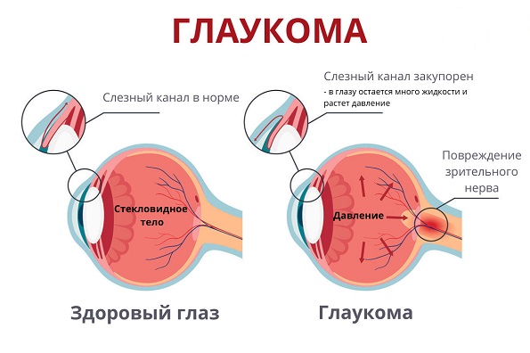 Глаукома